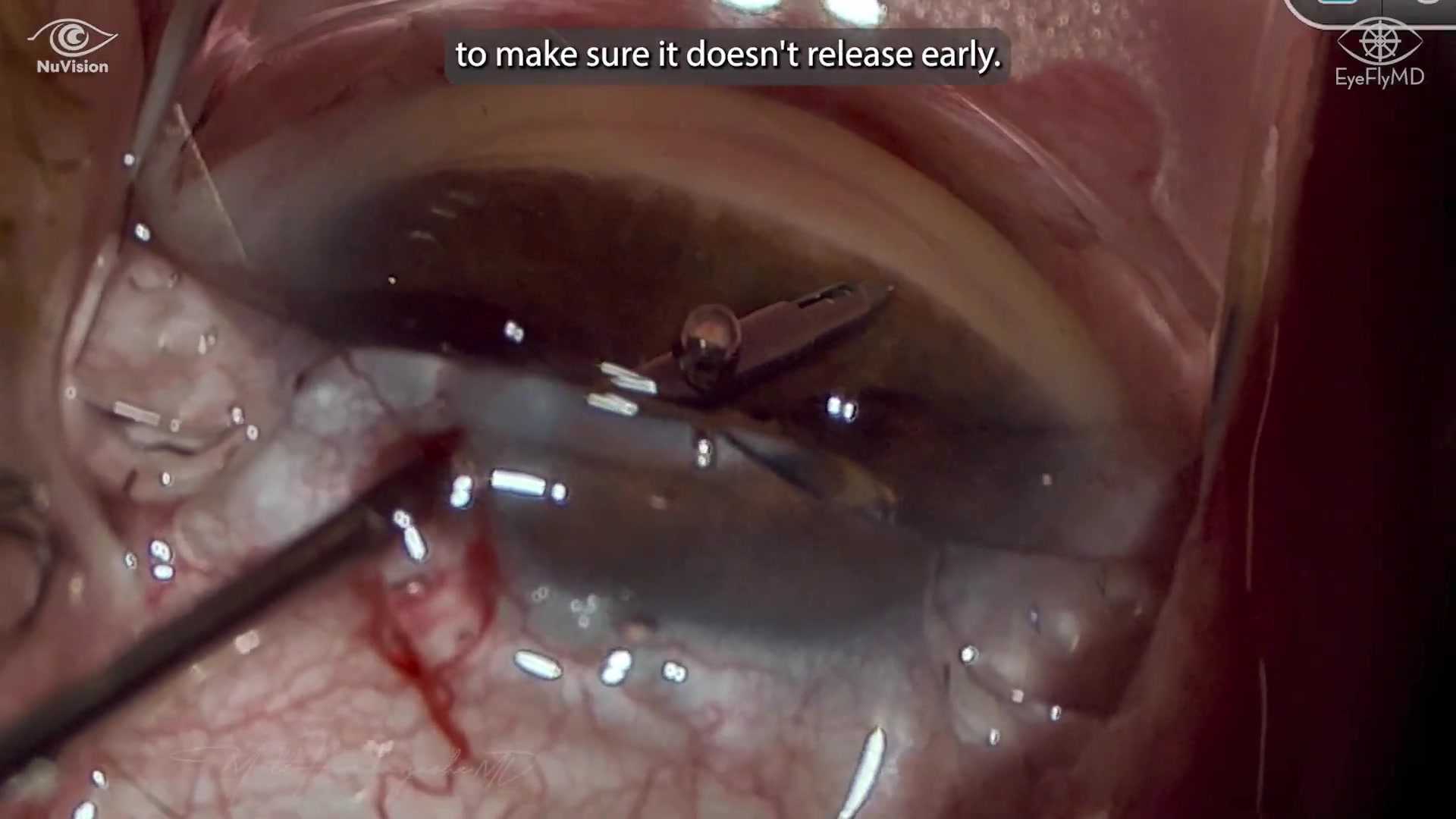 iDose implantation — watch on YouTube